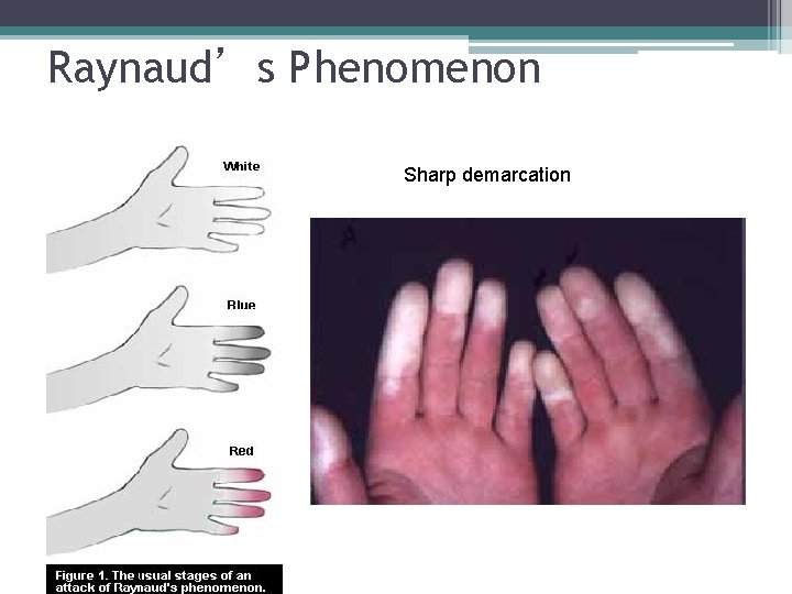 Raynaud’s Phenomenon Sharp demarcation 