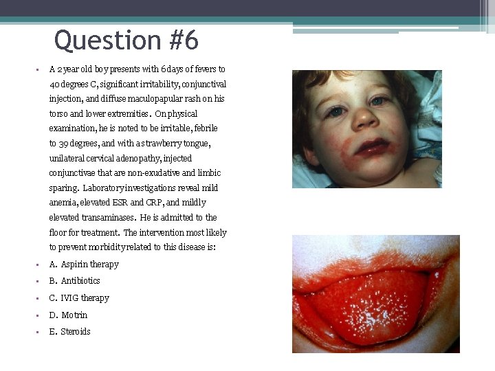 Question #6 • A 2 year old boy presents with 6 days of fevers