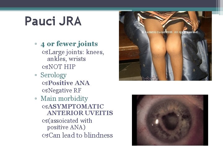 Pauci JRA ▫ 4 or fewer joints Large joints: knees, ankles, wrists NOT HIP