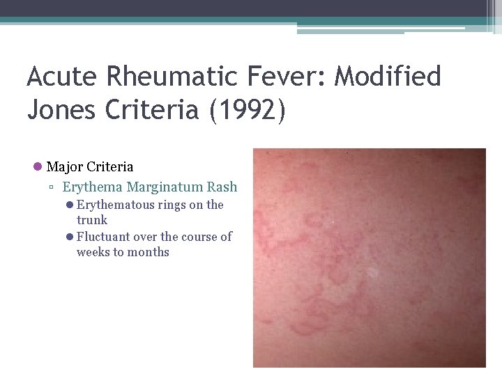 Acute Rheumatic Fever: Modified Jones Criteria (1992) l Major Criteria ▫ Erythema Marginatum Rash