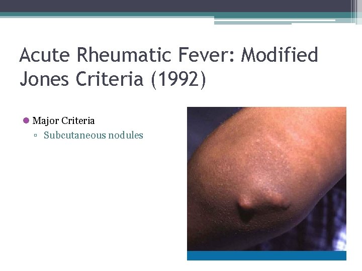 Acute Rheumatic Fever: Modified Jones Criteria (1992) l Major Criteria ▫ Subcutaneous nodules 