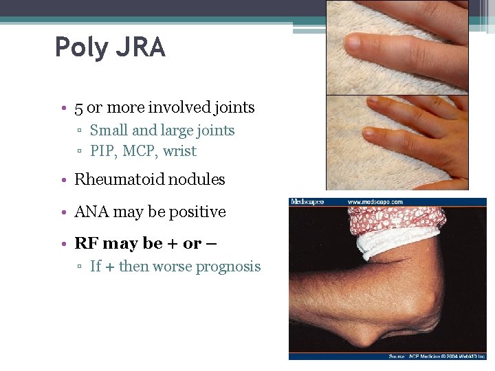 Poly JRA • 5 or more involved joints ▫ Small and large joints ▫