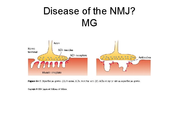 Disease of the NMJ? MG 