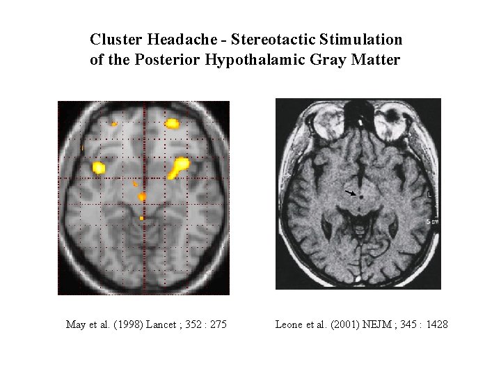 Cluster Headache - Stereotactic Stimulation of the Posterior Hypothalamic Gray Matter May et al.