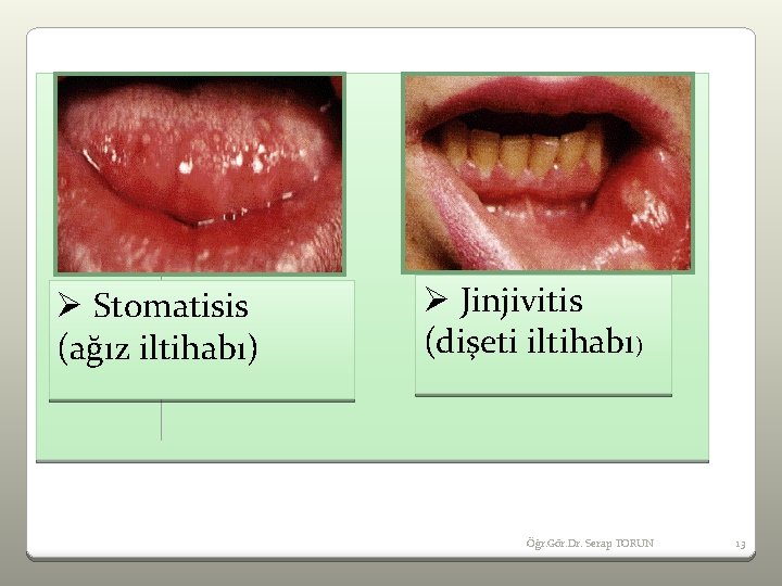 Ø Stomatisis (ağız iltihabı) Ø Jinjivitis (dişeti iltihabı) Öğr. Gör. Dr. Serap TORUN 13