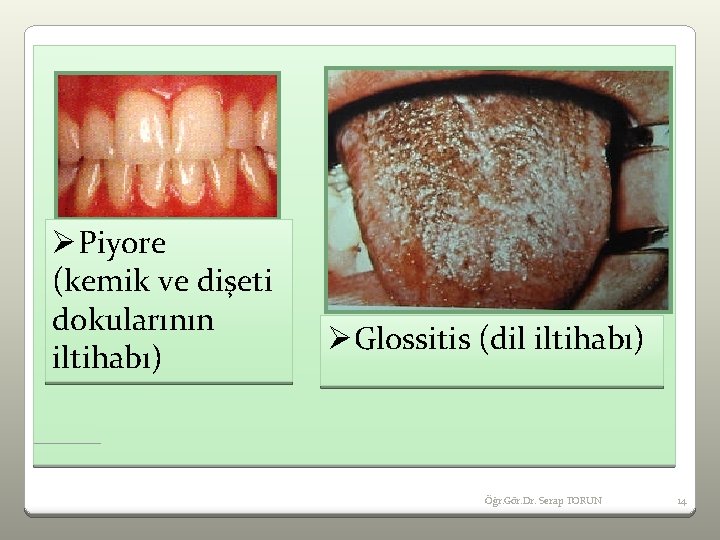 ØPiyore (kemik ve dişeti dokularının iltihabı) ØGlossitis (dil iltihabı) Öğr. Gör. Dr. Serap TORUN