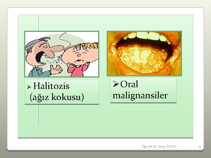 Ø Halitozis (ağız kokusu) ØOral malignansiler Öğr. Gör. Dr. Serap TORUN 15 