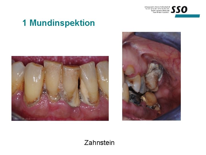 1 Mundinspektion Zahnstein 