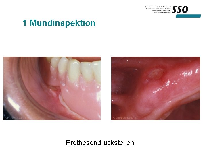 1 Mundinspektion Prothesendruckstellen 