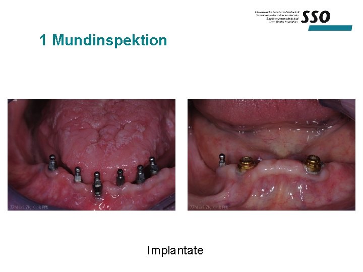 1 Mundinspektion Implantate 