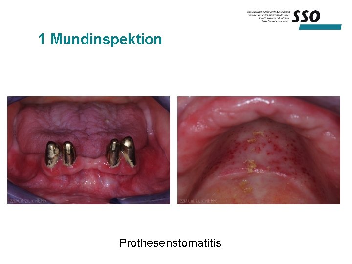 1 Mundinspektion Prothesenstomatitis 