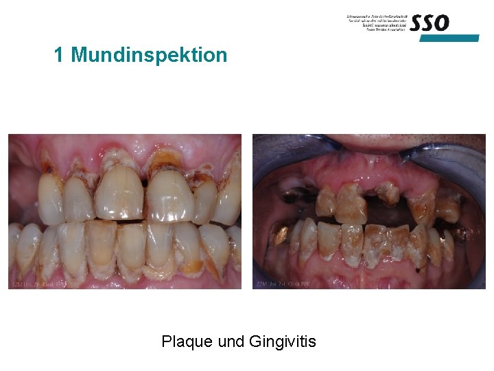 1 Mundinspektion Plaque und Gingivitis 