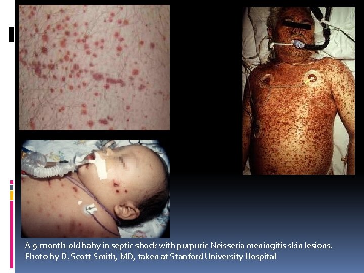 A 9 -month-old baby in septic shock with purpuric Neisseria meningitis skin lesions. Photo