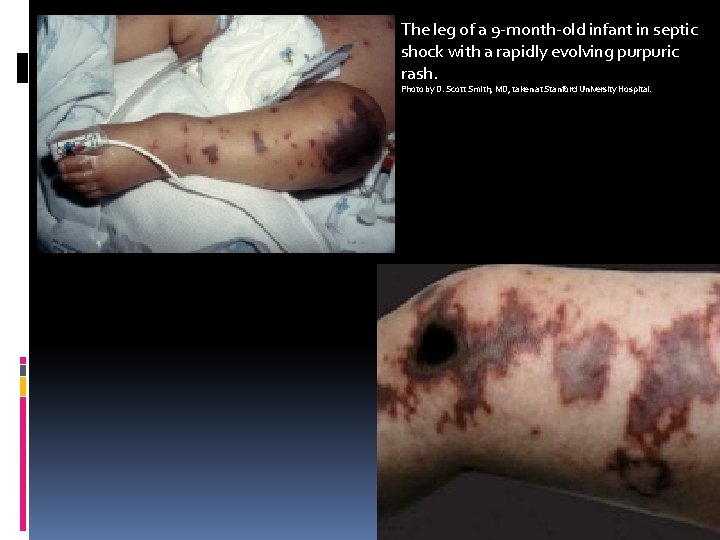 The leg of a 9 -month-old infant in septic shock with a rapidly evolving