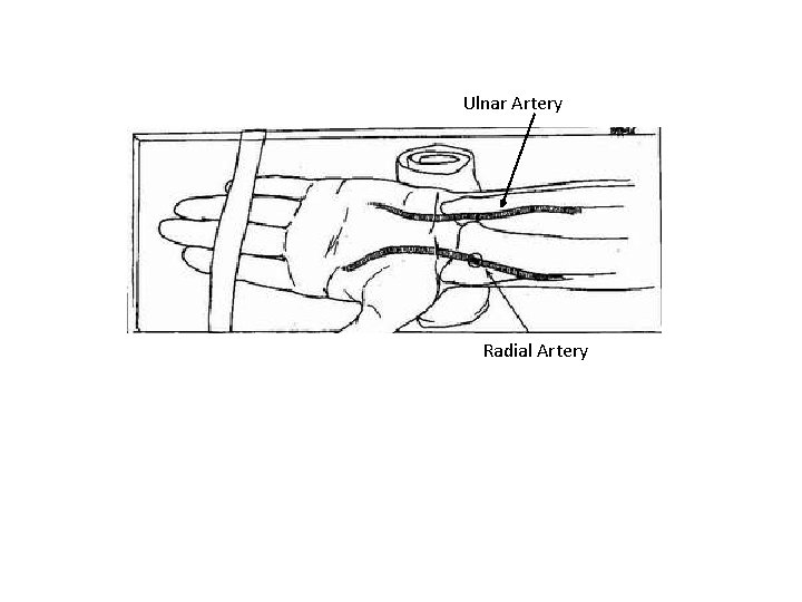 Ulnar Artery Radial Artery 
