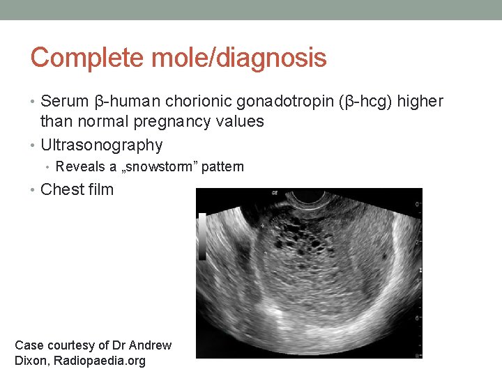 Complete mole/diagnosis • Serum β-human chorionic gonadotropin (β-hcg) higher than normal pregnancy values •