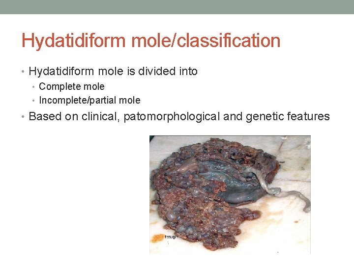 Hydatidiform mole/classification • Hydatidiform mole is divided into • Complete mole • Incomplete/partial mole