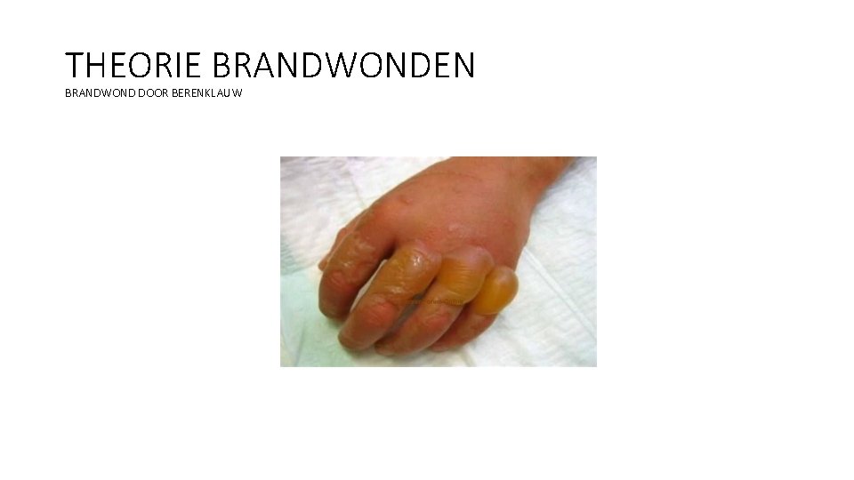 THEORIE BRANDWONDEN BRANDWOND DOOR BERENKLAUW 