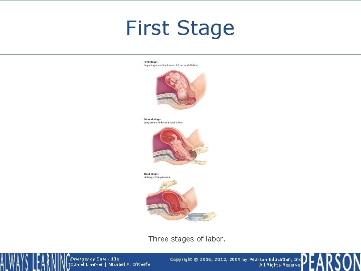 First Stage Three stages of labor. Emergency Care, 13 e Daniel Limmer | Michael