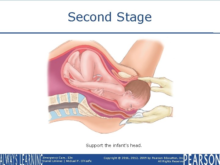 Second Stage Support the infant’s head. Emergency Care, 13 e Daniel Limmer | Michael