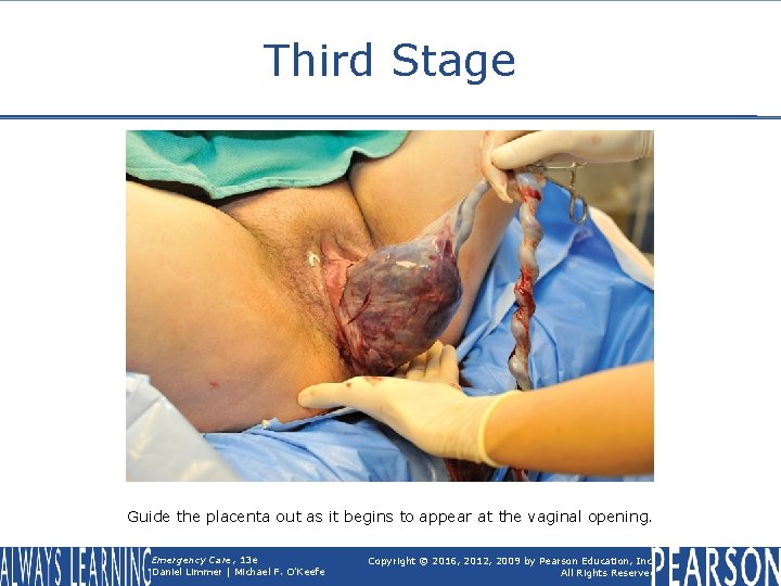 Third Stage Guide the placenta out as it begins to appear at the vaginal