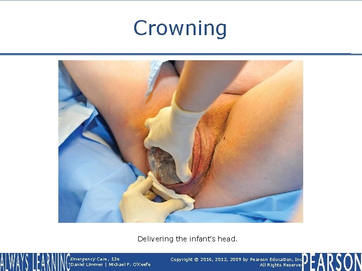 Crowning Delivering the infant’s head. Emergency Care, 13 e Daniel Limmer | Michael F.