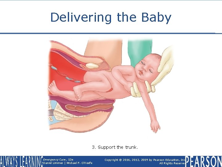 Delivering the Baby 3. Support the trunk. Emergency Care, 13 e Daniel Limmer |
