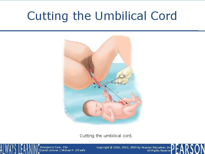 Cutting the Umbilical Cord Cutting the umbilical cord. Emergency Care, 13 e Daniel Limmer