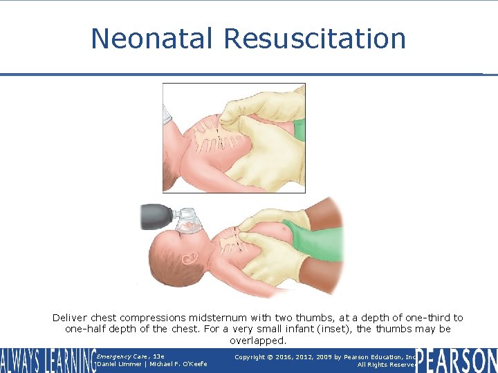 Neonatal Resuscitation Deliver chest compressions midsternum with two thumbs, at a depth of one-third