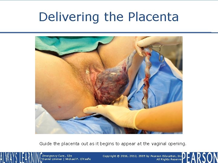 Delivering the Placenta Guide the placenta out as it begins to appear at the