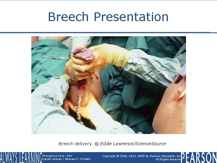 Breech Presentation Breech delivery. © Eddie Lawrence/Science. Source Emergency Care, 13 e Daniel Limmer
