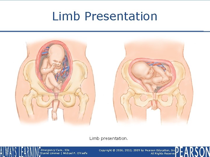 Limb Presentation Limb presentation. Emergency Care, 13 e Daniel Limmer | Michael F. O'Keefe