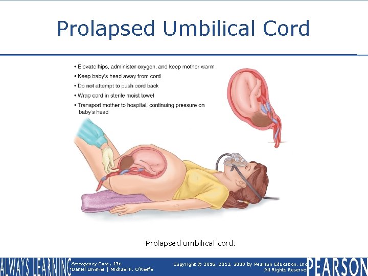 Prolapsed Umbilical Cord Prolapsed umbilical cord. Emergency Care, 13 e Daniel Limmer | Michael
