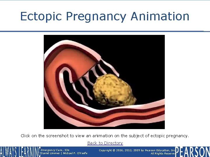 Ectopic Pregnancy Animation Click on the screenshot to view an animation on the subject