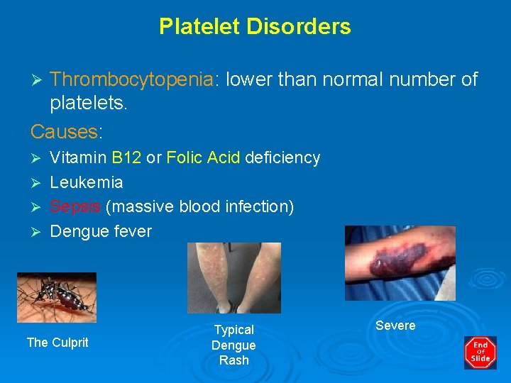 Platelet Disorders Thrombocytopenia: lower than normal number of platelets. Causes: Ø Ø Ø Vitamin