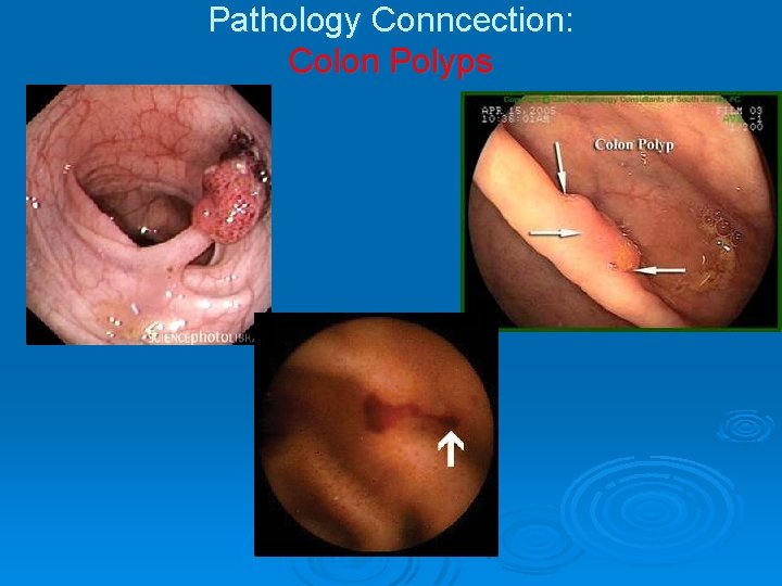 Pathology Conncection: Colon Polyps 