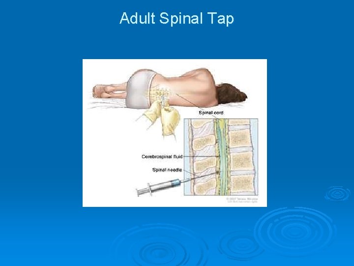 Adult Spinal Tap 