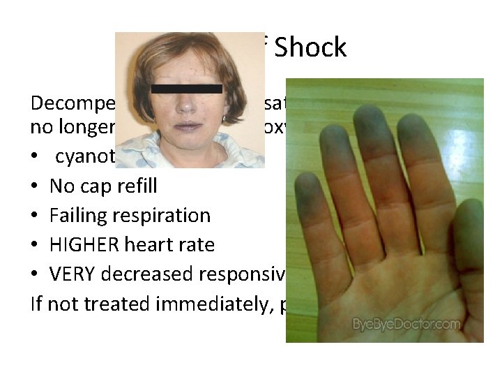 Stages of Shock Decompensated- compensatory measures can no longer deliver enough oxygen to organs.