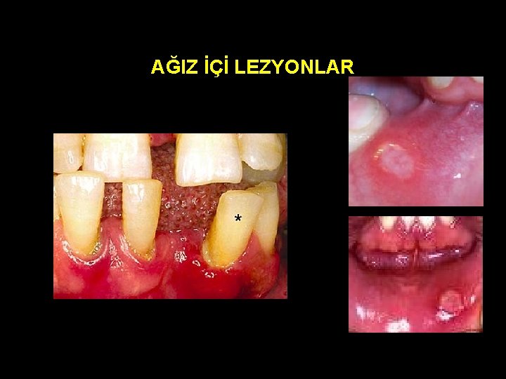 AĞIZ İÇİ LEZYONLAR 