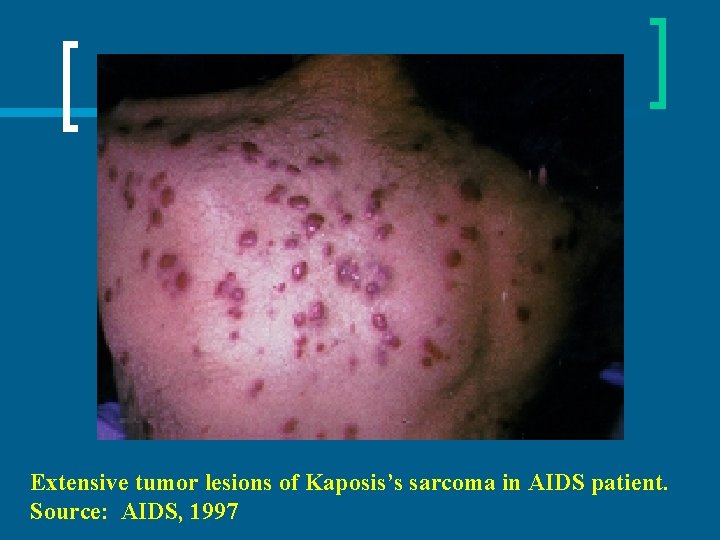 Extensive tumor lesions of Kaposis’s sarcoma in AIDS patient. Source: AIDS, 1997 