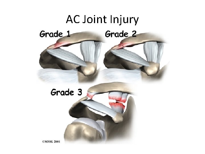 AC Joint Injury 