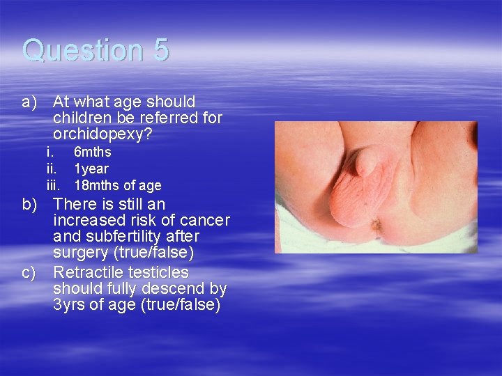 Question 5 a) At what age should children be referred for orchidopexy? i. 6