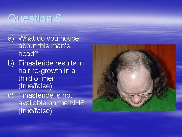 Question 6 a) What do you notice about this man’s head? b) Finasteride results