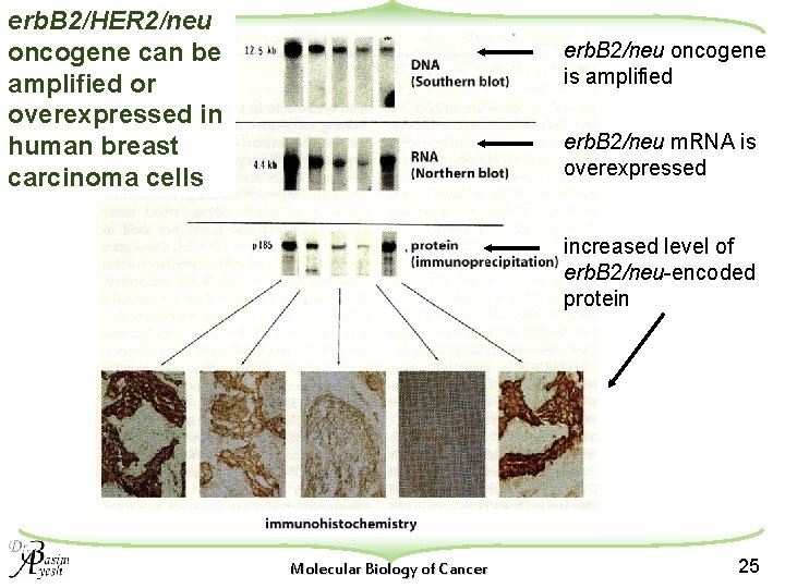 erb. B 2/HER 2/neu oncogene can be amplified or overexpressed in human breast carcinoma