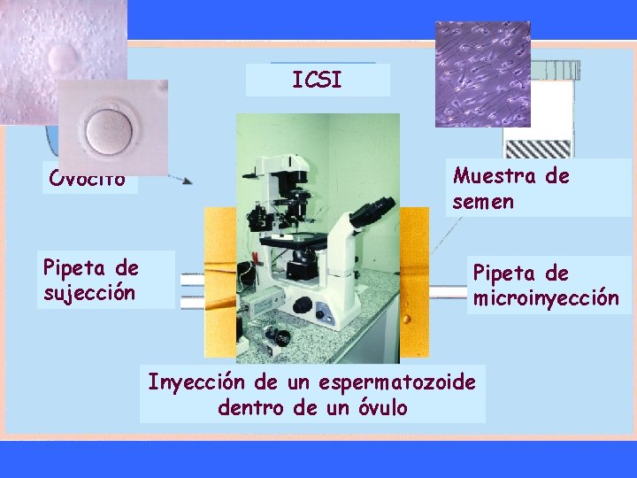 ICSI Ovocito Pipeta de sujección Muestra de semen Pipeta de microinyección Inyección de un