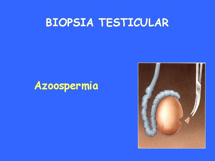 BIOPSIA TESTICULAR Azoospermia 
