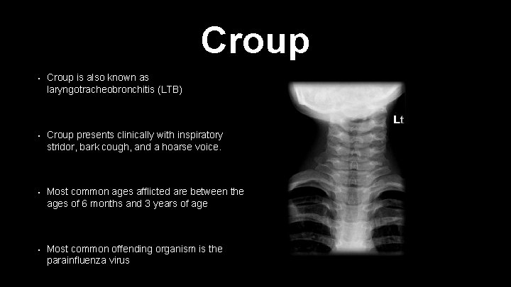 Croup • Croup is also known as laryngotracheobronchitis (LTB) • Croup presents clinically with