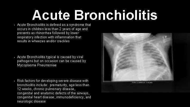 Acute Bronchiolitis • Acute Bronchiolitis is defined as a syndrome that occurs in children