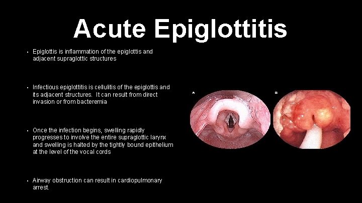 Acute Epiglottitis • Epiglottis is inflammation of the epiglottis and adjacent supraglottic structures •