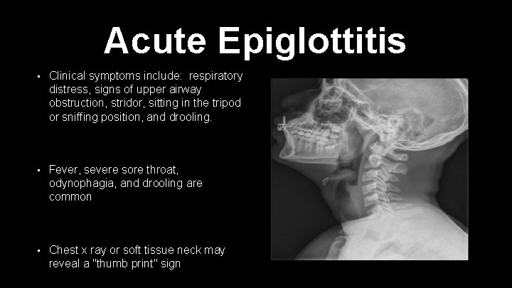 Acute Epiglottitis • Clinical symptoms include: respiratory distress, signs of upper airway obstruction, stridor,